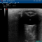 Echo oog cataract